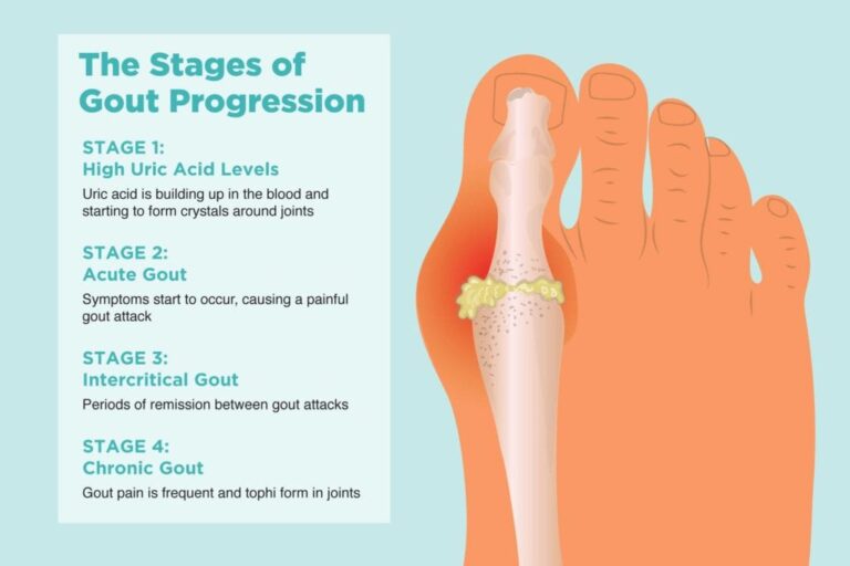 Gout-foot-explained