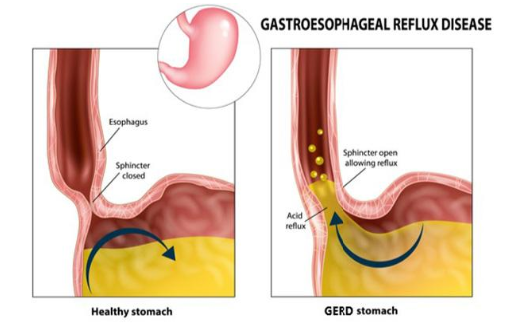 GERD
